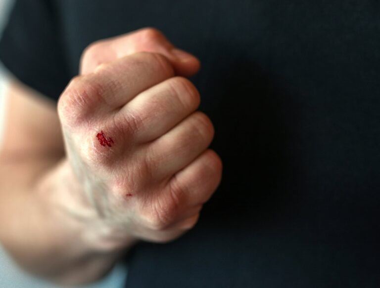 A man's bloodied fist used to illustrate article about celebrities accused of domestic violence