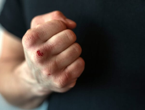 Corporal Injury to a Spouse or Cohabitant Charges in Vista 1 A bloodied fist to illustrate corporal injury to a spouse or cohabitant charges in California